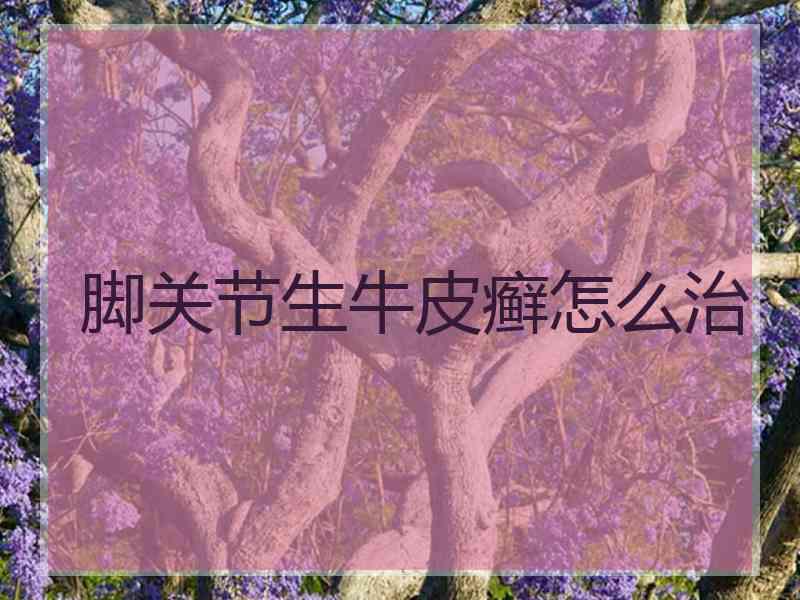 脚关节生牛皮癣怎么治 脚关节生牛皮癣怎么治